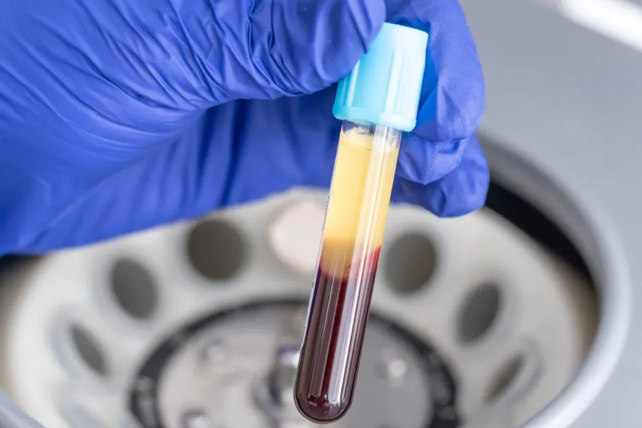 Platelet-rich fibrin preparation for dental treatment
